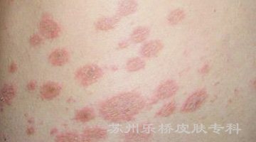 感染白色糠疹有什么症状